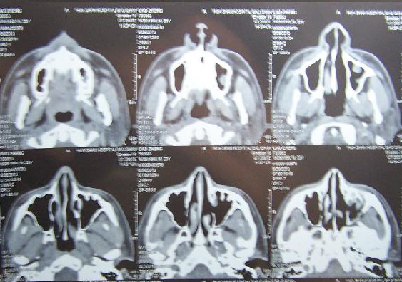 张轩亦的鼻部ct图